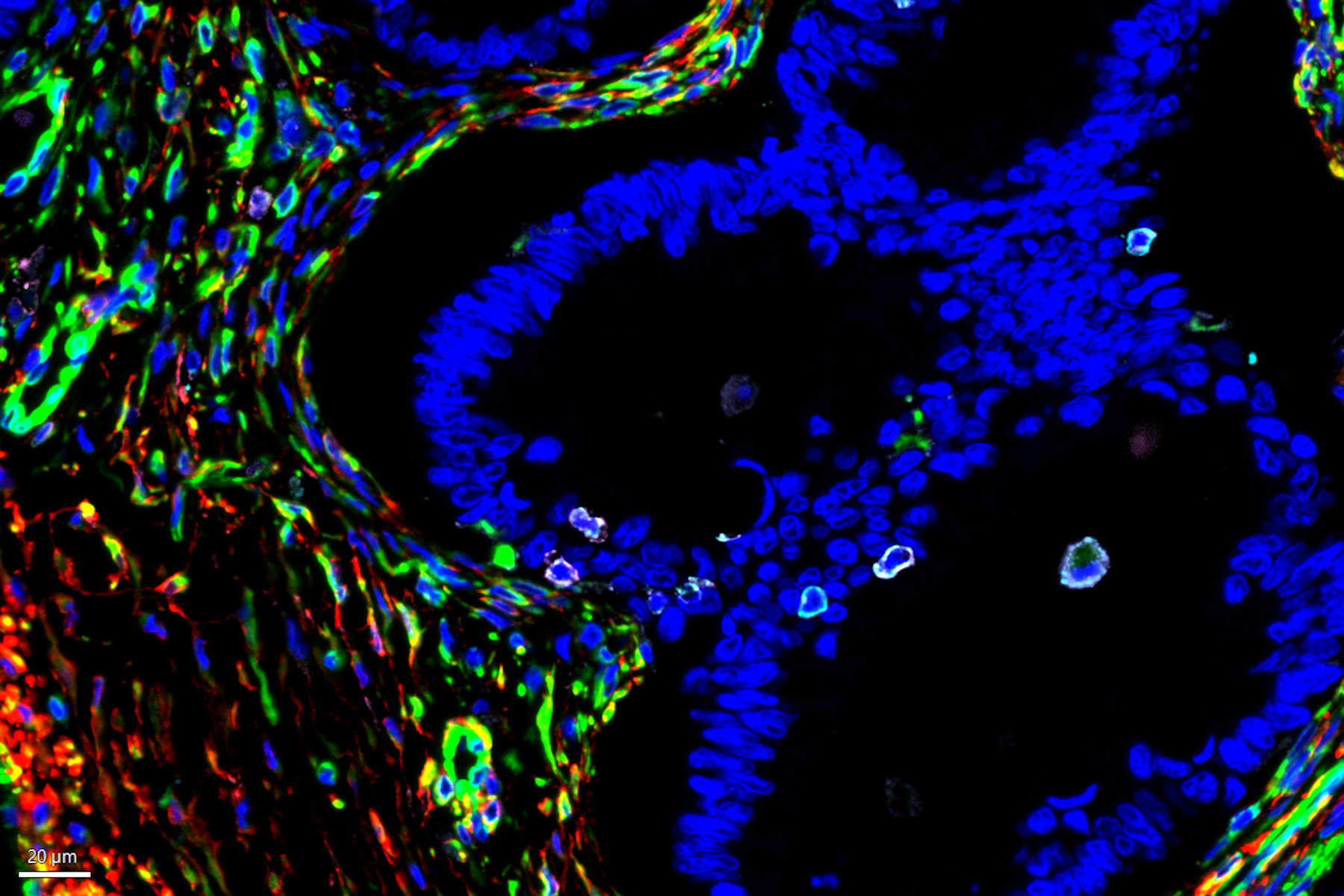 Multiplexed Cell DIVE imaging of selected clusters and unique cell populations identified in mucinous cystadenocarcinoma of the ovary.