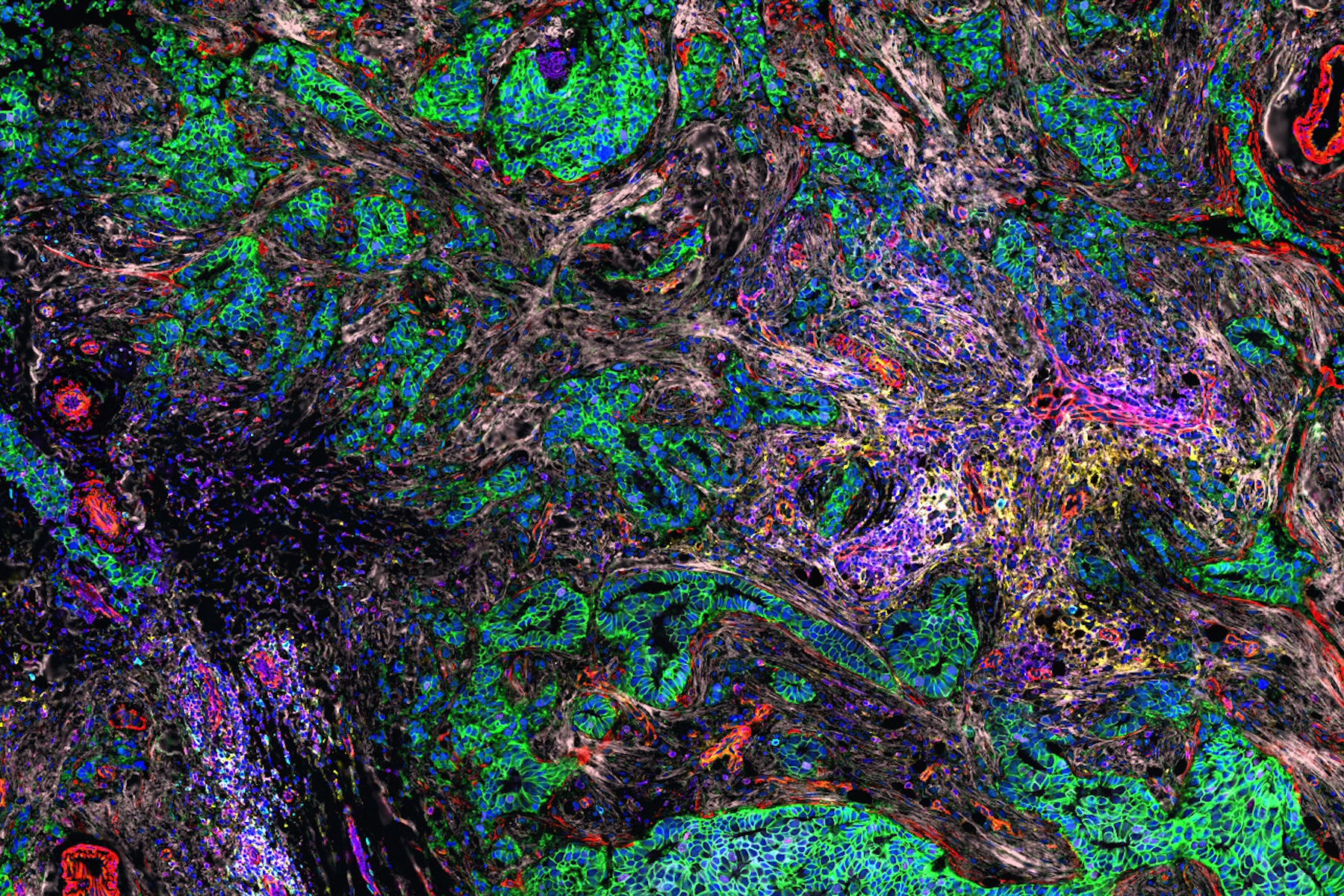 Cell DIVE multiplexed image of FFPE tissue section from human invasive ductal carcinoma (IDC)