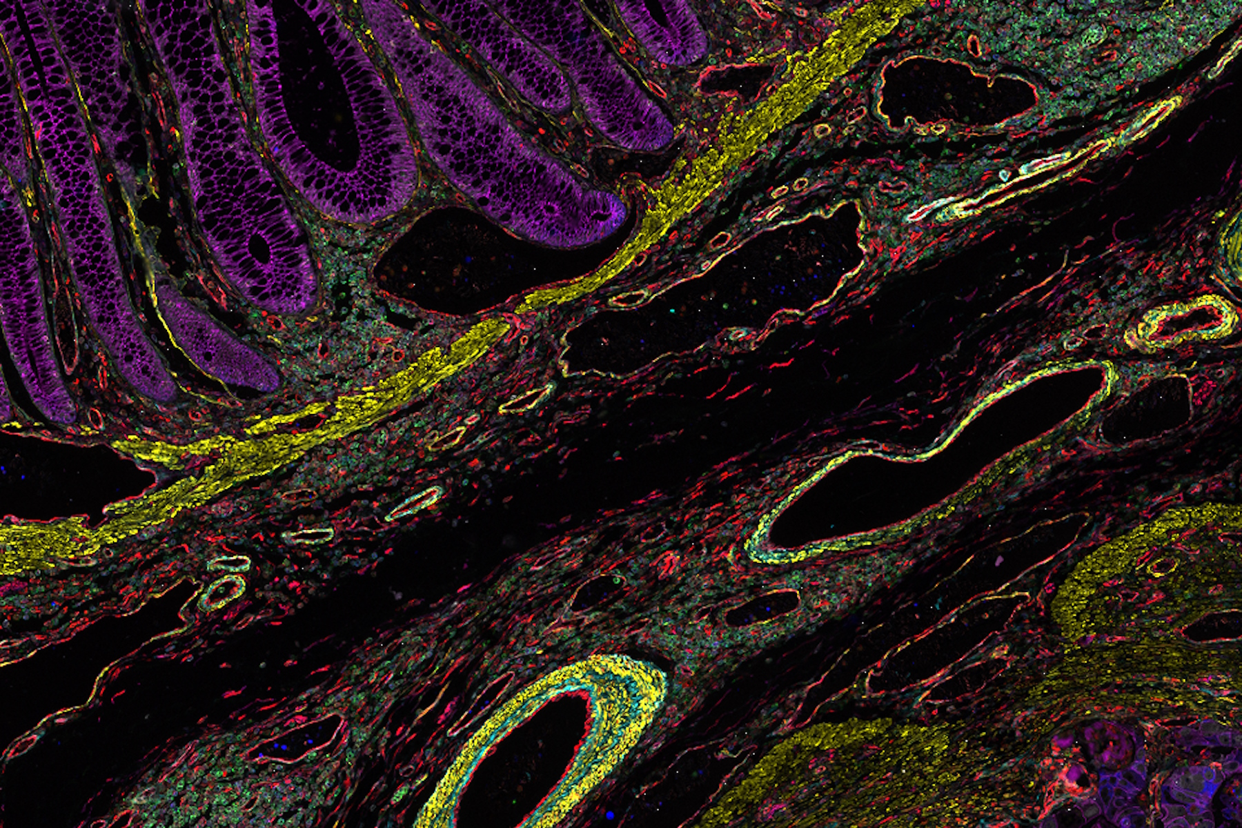Colon adenocarcinoma and normal colon at the tumor margin. 13 biomarkers shown including Cadherin, CD3, CD4, CD8, CD20, CD31, CD45, Collagen, Caspase 9, BCL2, Beta-Catenin, Vimentin, and Smooth Muscle Actin.