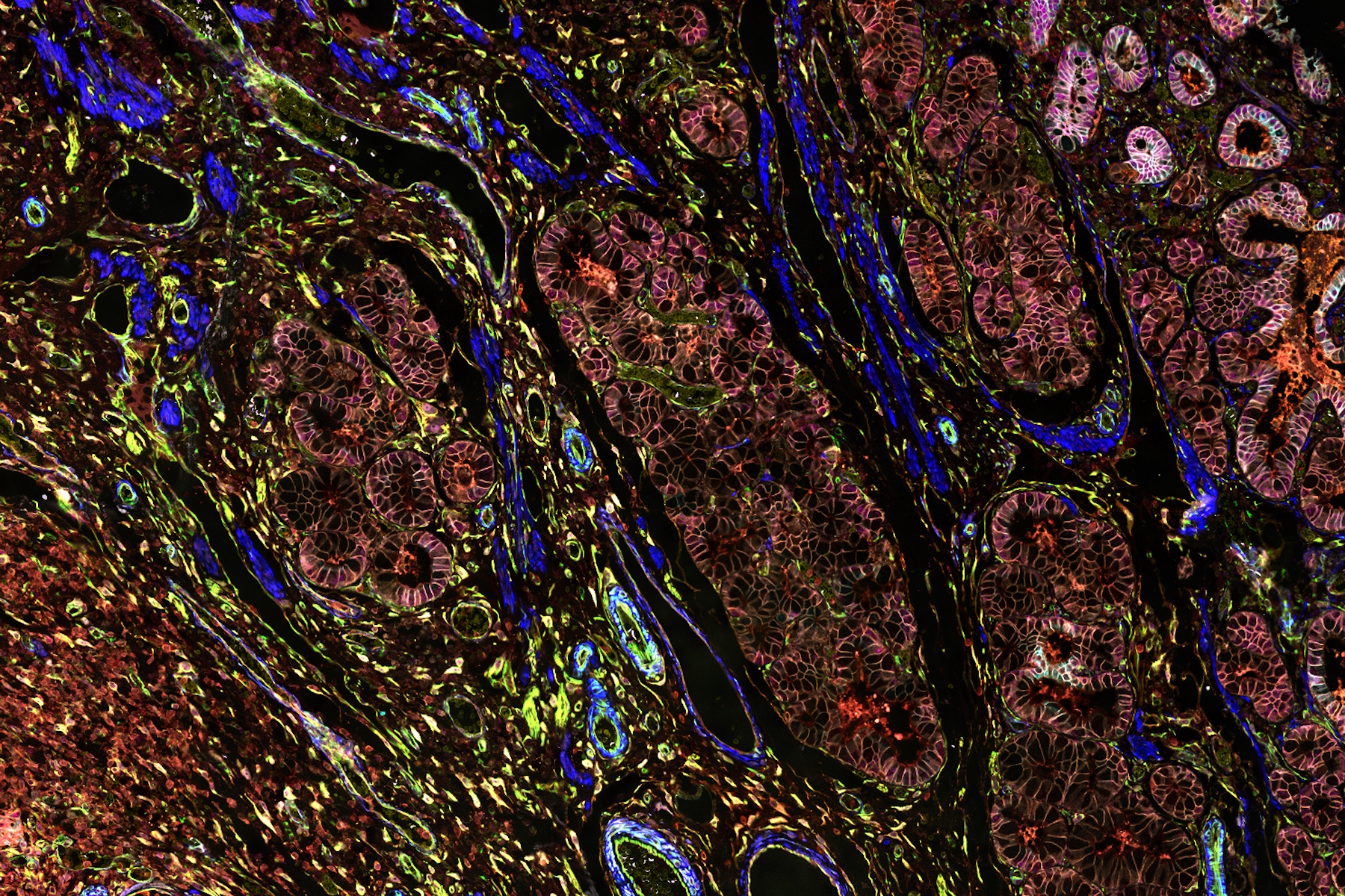 Pancreatic Ductal Adenocarcinoma with 11 Aerobic Glycolysis/Warburg Effect biomarkers shown – BCAT, Glut1, HK2, HTR2B, LDHA, NaKATPase, PCAD, PCK26, PKM2, SMA1, and Vimentin.