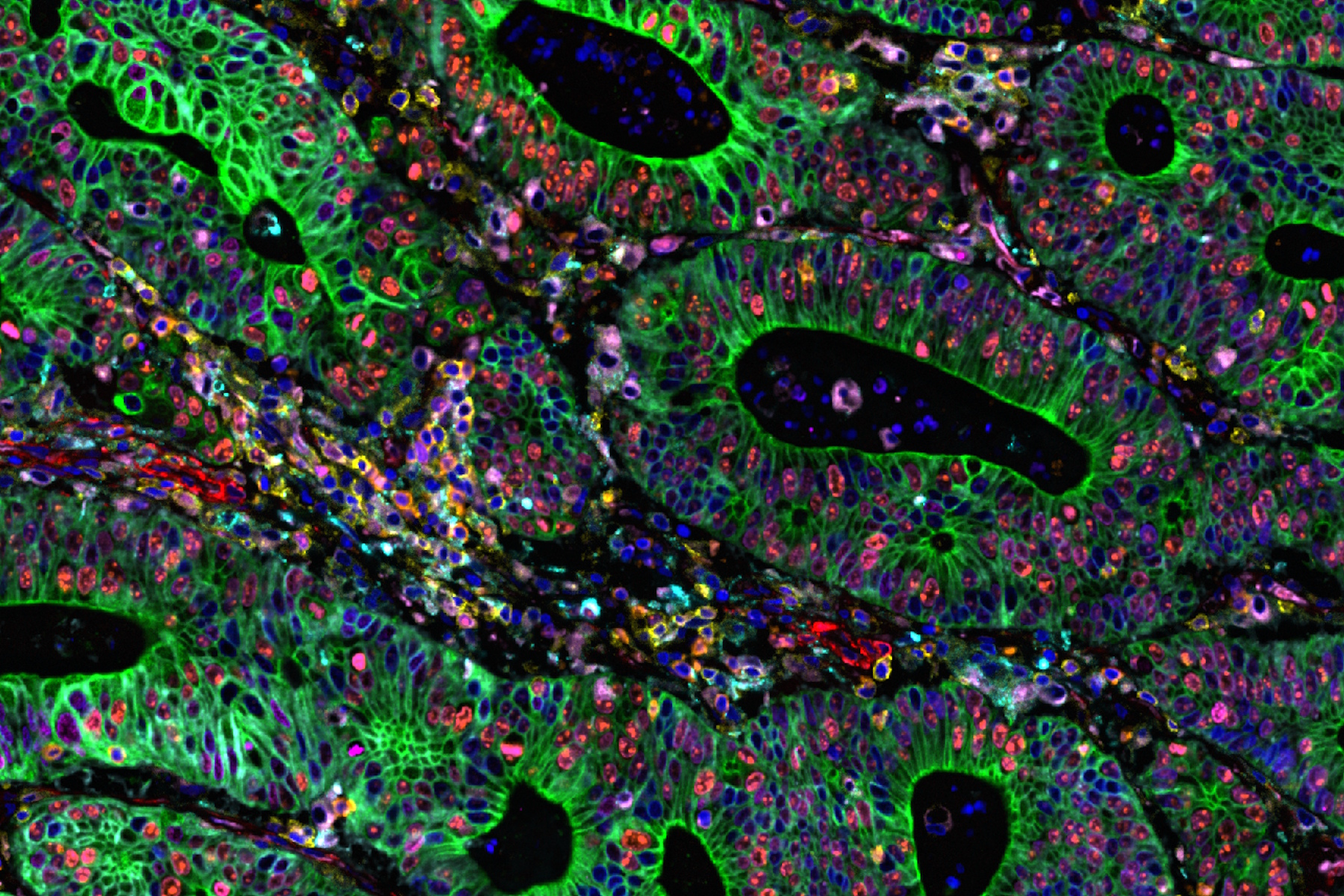 Cell DIVE multiplexed image of FFPE tissue section from human colon adenocarcinoma tissue.