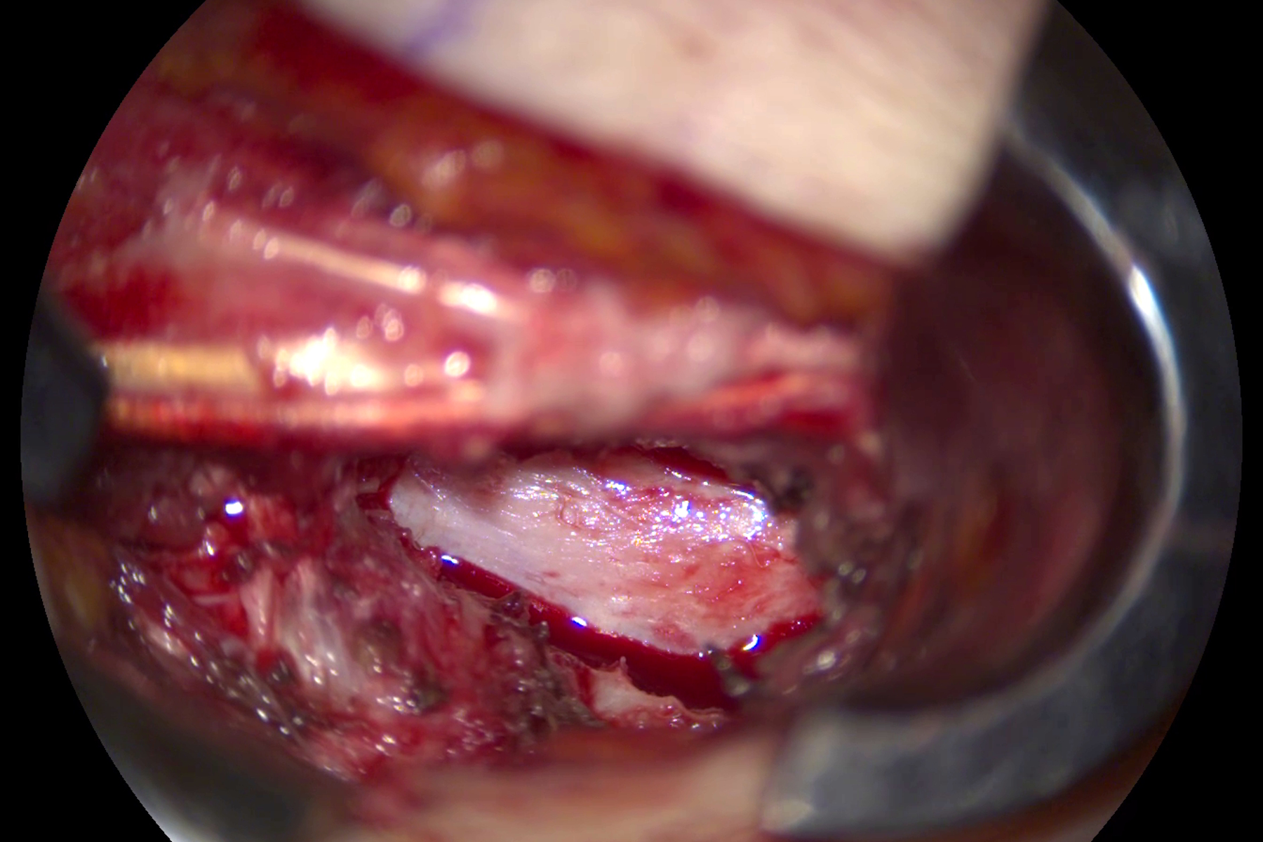 Surgical incision in minimally invasive spine surgery (MISS) case. Image courtesy of Dr. A. Alfieri, Chief Physician & Head of Clinic of Neurosurgery & Spinal Surgery, Cantonal Hospital Winterthur, Switzerland.