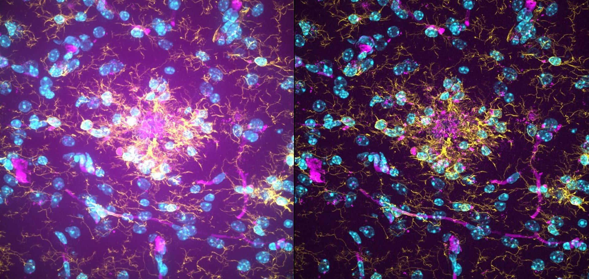 Characterization of microglial morphology around brain plaques in app/ps1 mice. Imaged using THUNDER Imager Cell Spinning Disk. Shown are both the spinning disk image (left) and the same image after THUNDER Computational Clearing was applied (right). Sample courtesy of Patricia M. Tazo and Aroa S. Maroto, Silvia De Santis’ laboratory, Instituto de Neurociencias CSIC-UMH, Alicante, Spain.