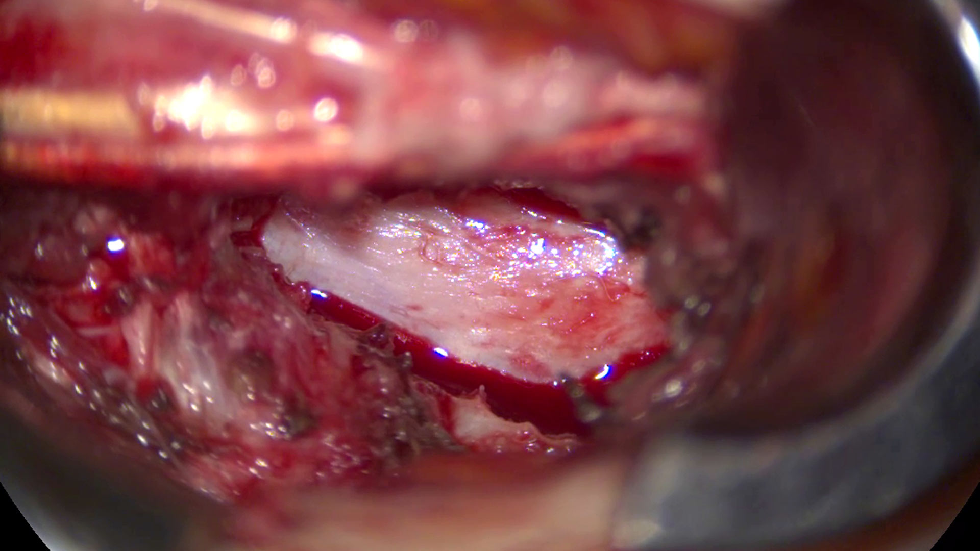 Spine surgery using the ARveo 8 surgical microscope. Dr. Alfieri, MD, Chief Physician and Head of Clinic for Neurosurgery & Spine Surgery