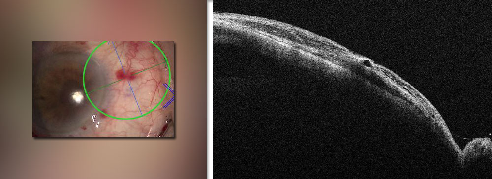 La visualizzazione al microscopio durante l'intervento al glaucoma (a sinistra) supportata da EnFocus OCT (a destra) mostra la profondita di uno XEN gel stent dopo il posizionamento. Immagine fornita da Gerd Geerling, MD, PhD, FEBO, Department of Ophthalmology, University Hospital Dusseldorf, Germany.