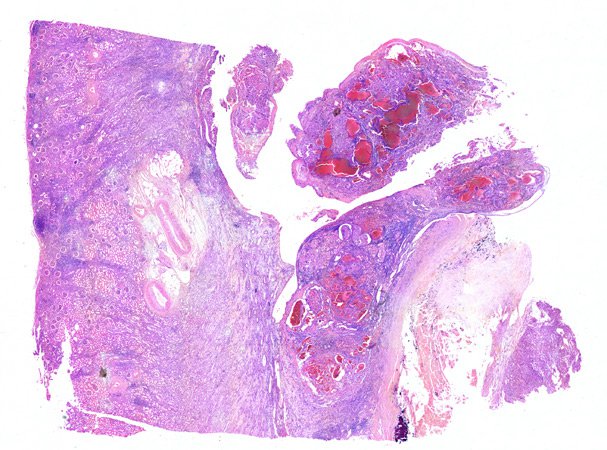 Overview of H&E stained section with tumor areas. Human kidney Overview of H&E stained section with tumor areas. Human kidney