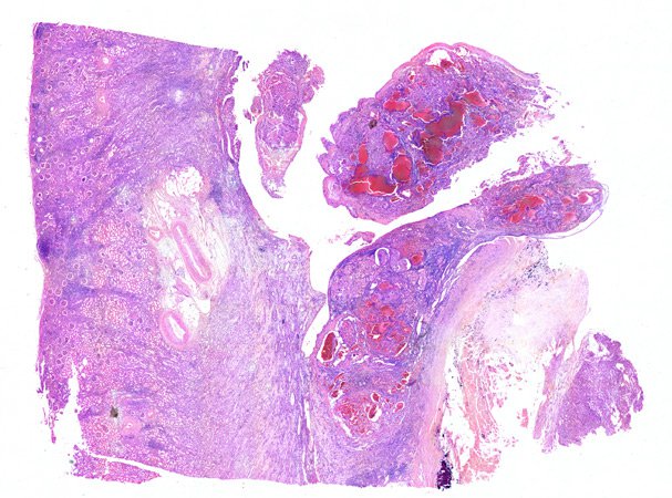 Overview of H&E stained section with tumor areas. Human kidney