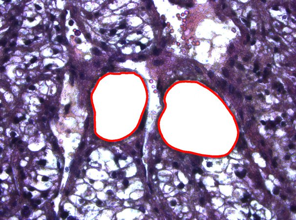 Human kidney tissue after laser microdissection. H & E staining. Human kidney tissue after laser microdissection. H & E staining.