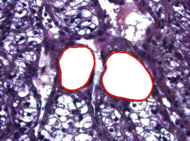 Human kidney tissue after laser microdissection. H & E staining.