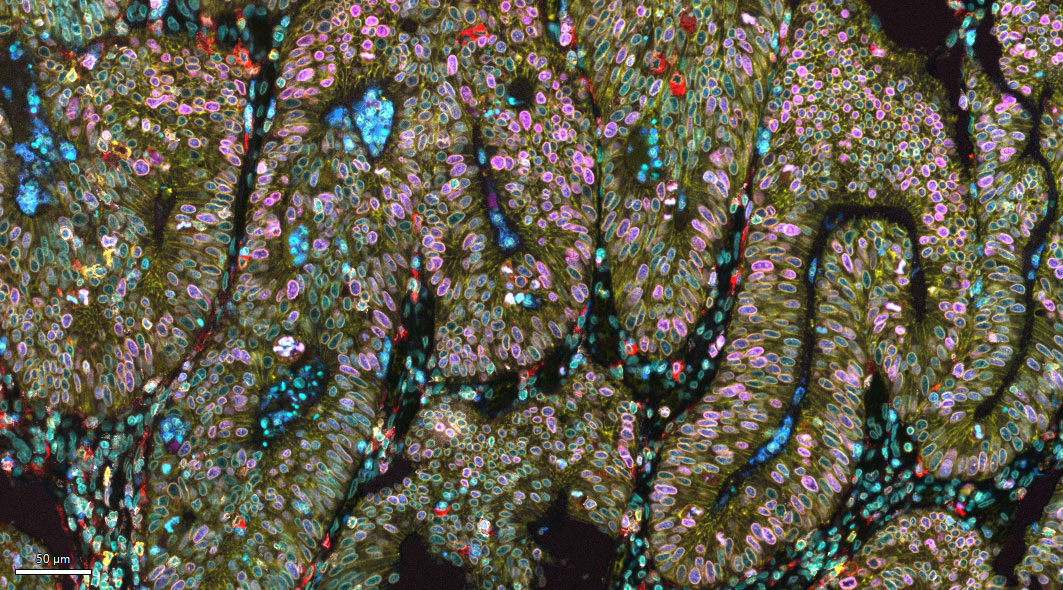 Colon Mic Adenocarc DAPI